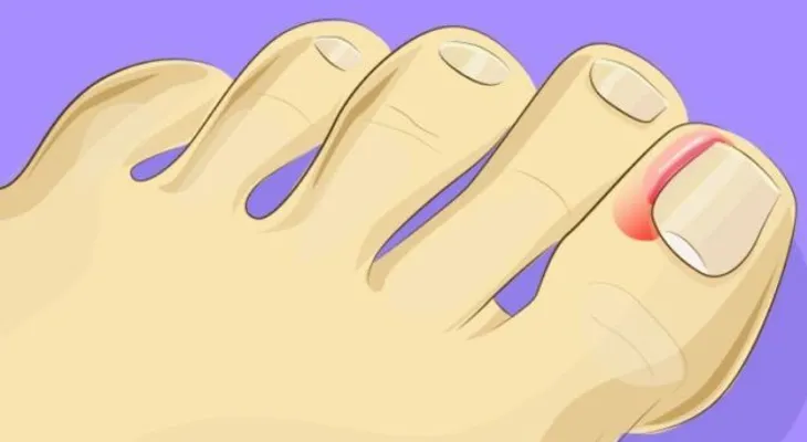 Es fácil tratar las uñas enterradas sin necesidad de operar (VIDEO)