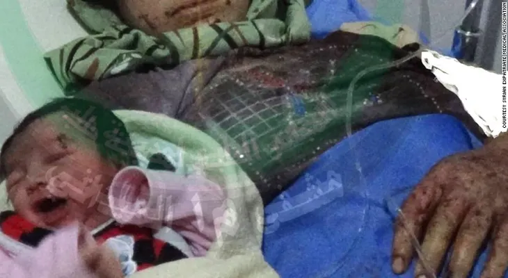 Guerra civil en Siria: nace una bebé con herida de metralla en la frente