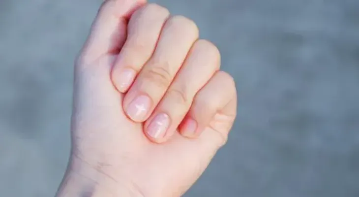 El aspecto de las uñas puede ser un síntoma de algunas enfermedades