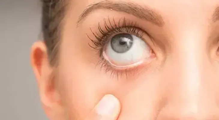 La alergia ocular del ojo seco, cómo diferenciarla 