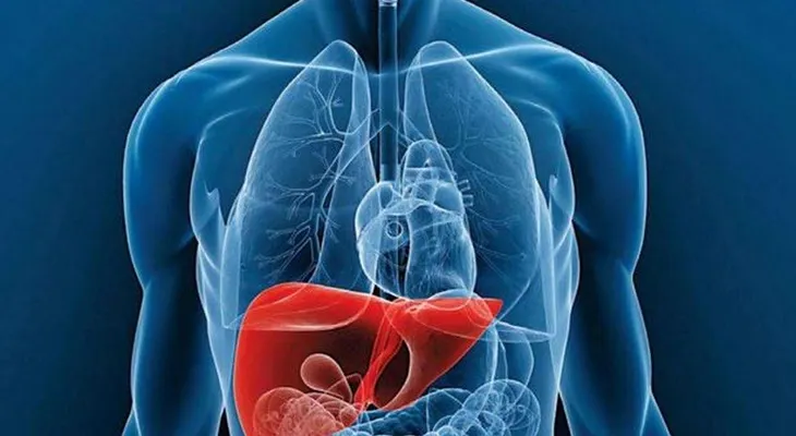  Hígado graso; una enfermedad "silenciosa" que puede derivar en cirrosis o cáncer 