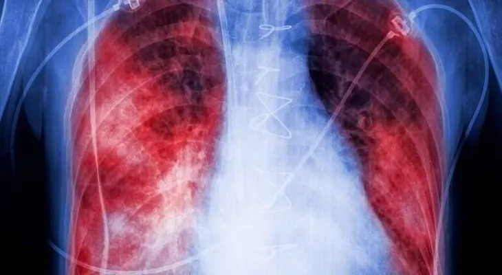 Qué es la neumonía bilateral y qué produce en el cuerpo