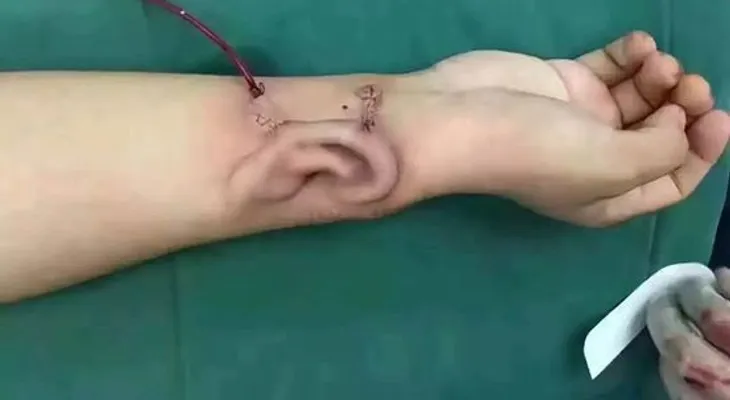 Tuvieron que hacerle una oreja en el brazo porque la perdió en un accidente