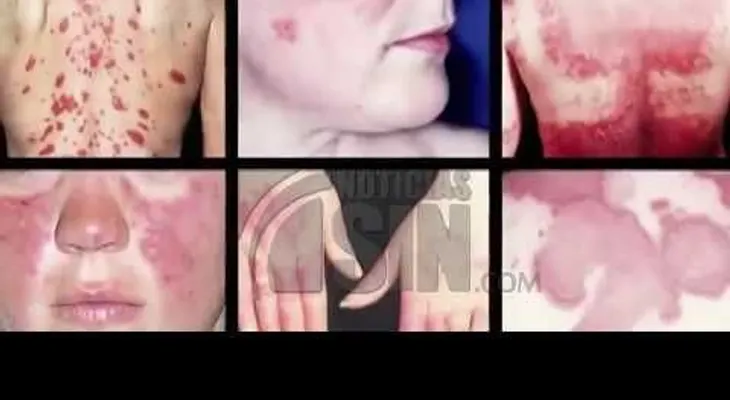 Más de 100 millones de personas afectadas por Lupus en el MUNDO