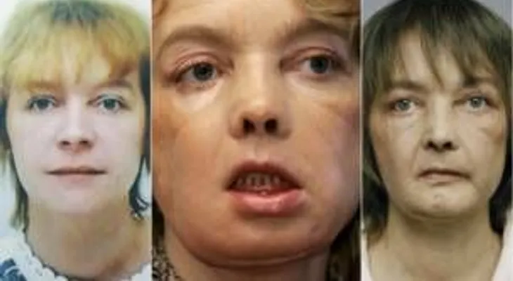 Muere primera mujer con trasplante en la cara: principales trasplantes en el mundo