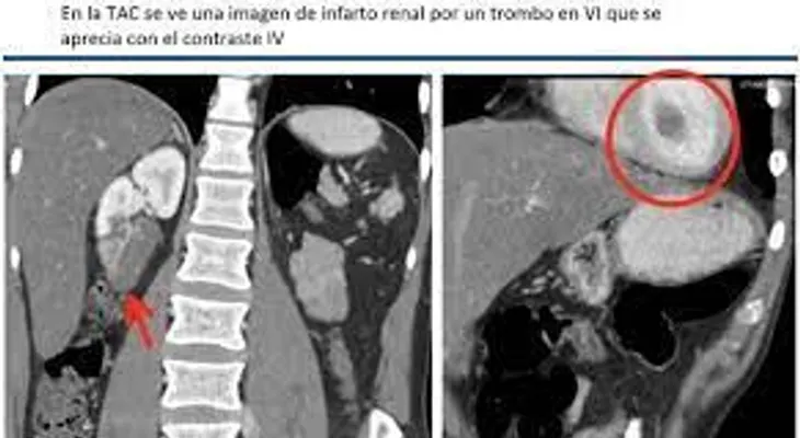Tac abdominopelvica sin contraste
