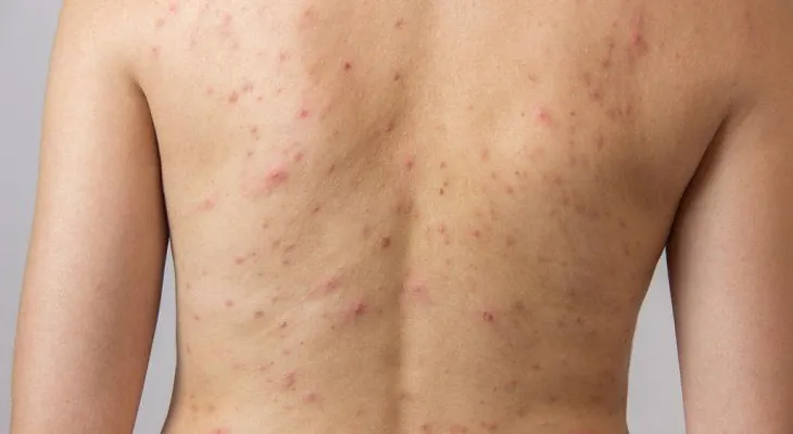 Acné en la espalda y pecho causas y tratamientos naturales