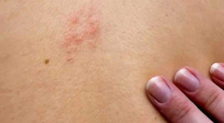 Las micosis cutáneas son enfermedades transmitida por gatos, perros y otros animales 
