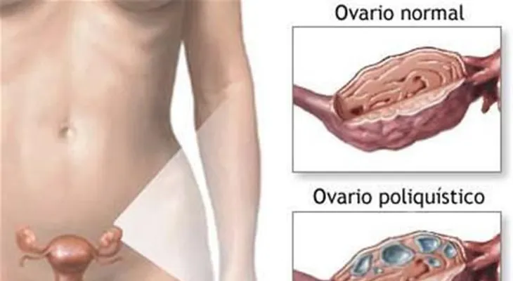 Síndrome de Ovario Poliquístico: un padecimiento aleatorio entre las mujeres