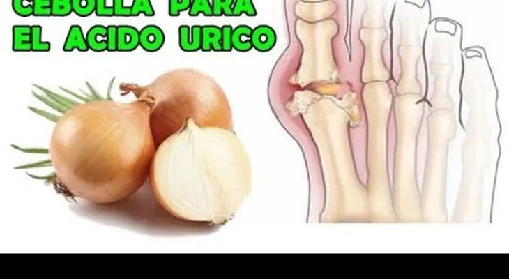 Ácido úrico eliminalo con solo 2 cebollas 