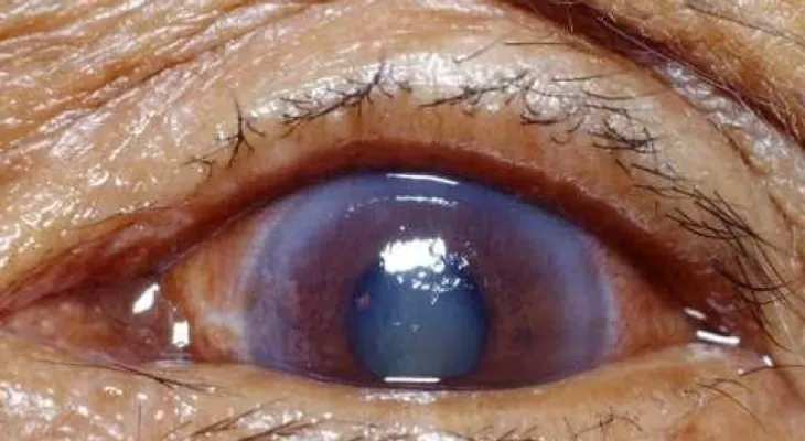 El glaucoma se roba silenciosamente la vista