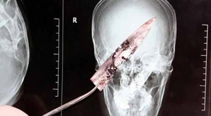 Un hombre vivió cuatro años con un cuchillo incrustado en la cabeza 