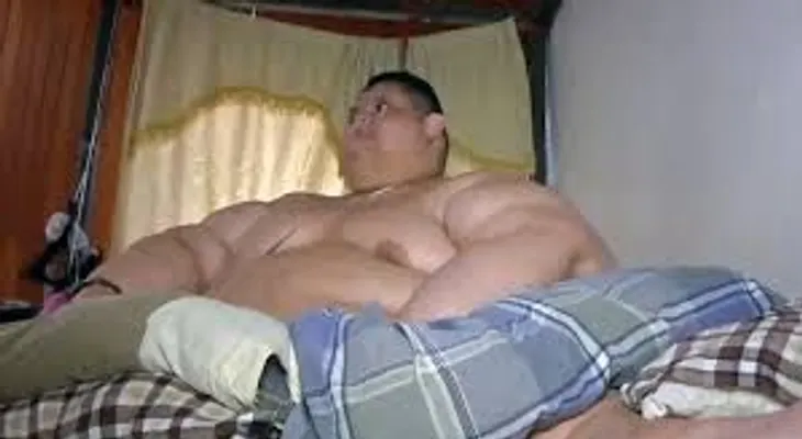 Hombre más obeso del mundo vive sus horas más críticas, dice médico que lo operó