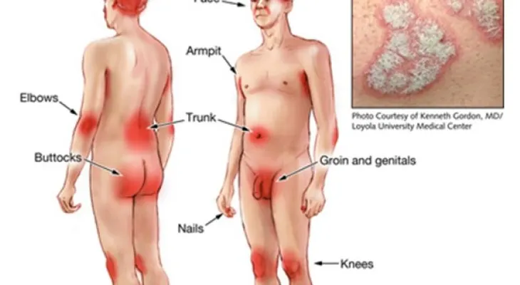 La Psoriasis puede mejorar con un estilo de vida saludable, Día Mundial 29Oct