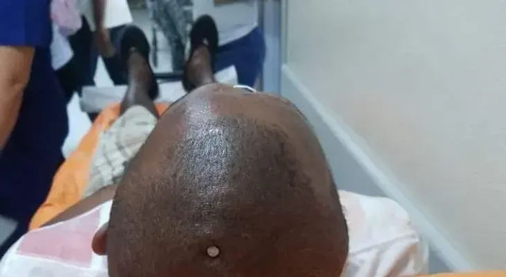 Un joven (Natanael García), se clava un clavo en la cabeza, porque sintió el cerebro flojo; lograron salvarlo 