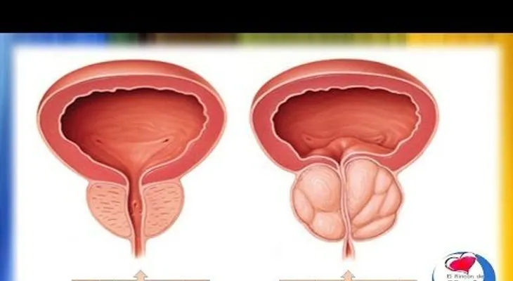 Anótalo: Remedios caseros para la prostata inflamada o prostatitis