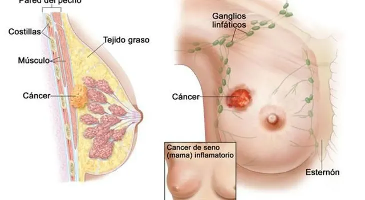 El país de origen mejoraría detención de cáncer de seno en latinas