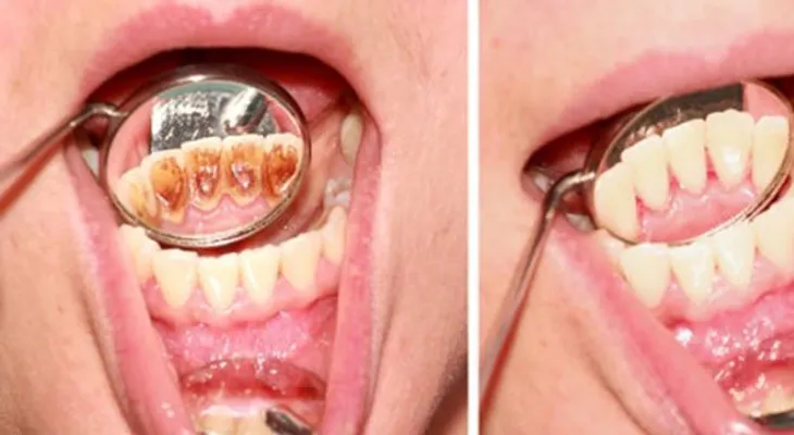 Como eliminar el sarro de los dientes en tan solo 5 minutos y sin gastar un centavo en dentista!