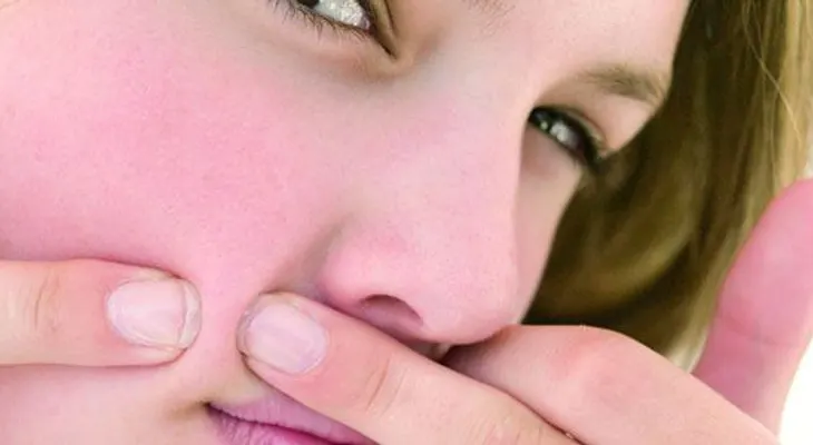 Sencillo tratamiento para prevenir el acné