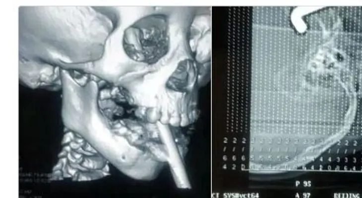 Niña china sobrevive después de que una barra de hierro le perforó el cerebro 