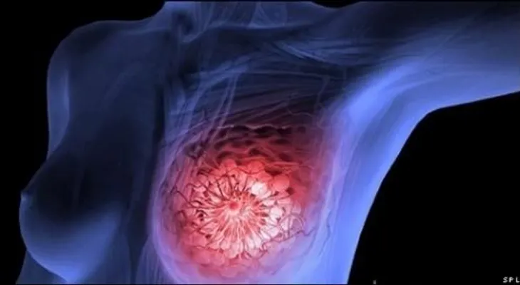 Descubren que lo tomamos a diario, y no sabemos el causante del cáncer de mama. Por favor compártelo.!