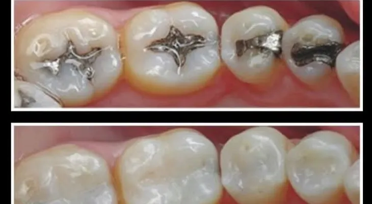 Despídete para siempre del metal en los dientes
