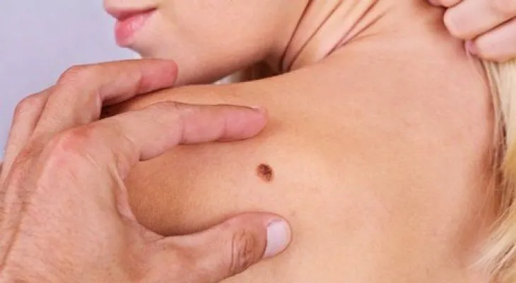 7 cosas que no conocías sobre el cáncer de piel