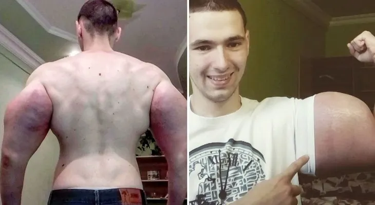 "Popeye": el joven fisicoculturista ruso al que critican por inyectarse aceite en los brazos