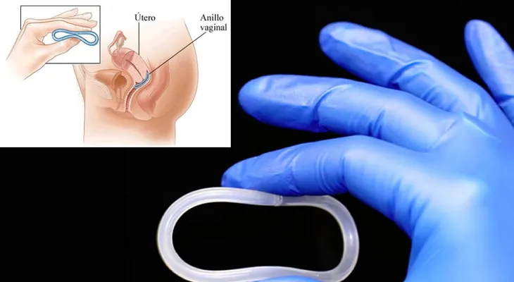 Crean un anillo vaginal que protege del VIH y del herpes
