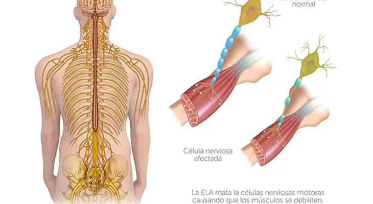 Esclerosis lateral amiotrófica: Enfermedad que provoca la muerte por insuficiencia respiratoria