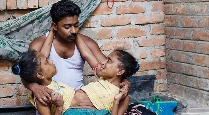 Dos siamesas en la India se enamoran del mismo hombre