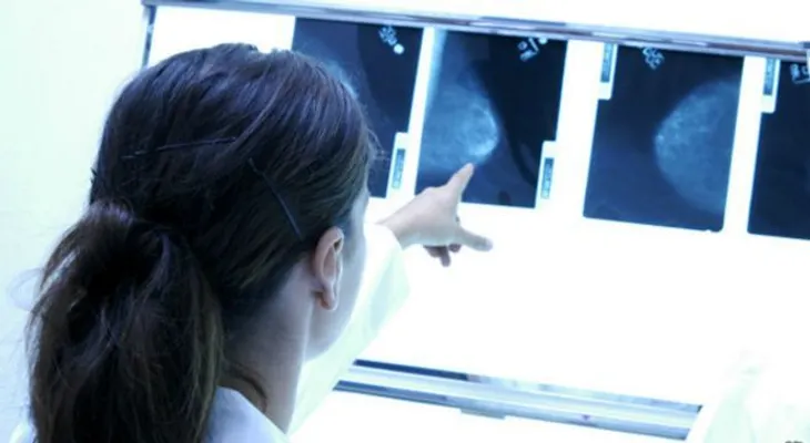 Un gen podría ayudar a proteger mujeres hispanas del cáncer de mama