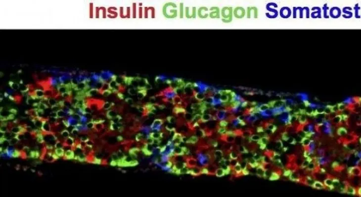 Trasplante de células madre, el futuro para curar y tratar la diabetes
