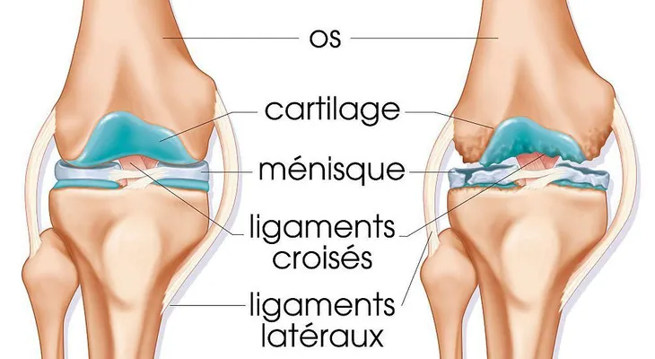 Células madre para curar la artrosis de rodilla