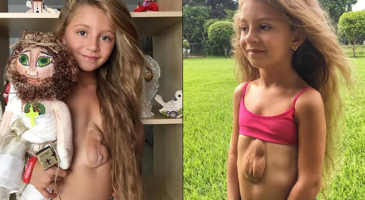El impactante caso de la niña que nació con el corazón fuera del pecho y cuenta su historia en Instagram