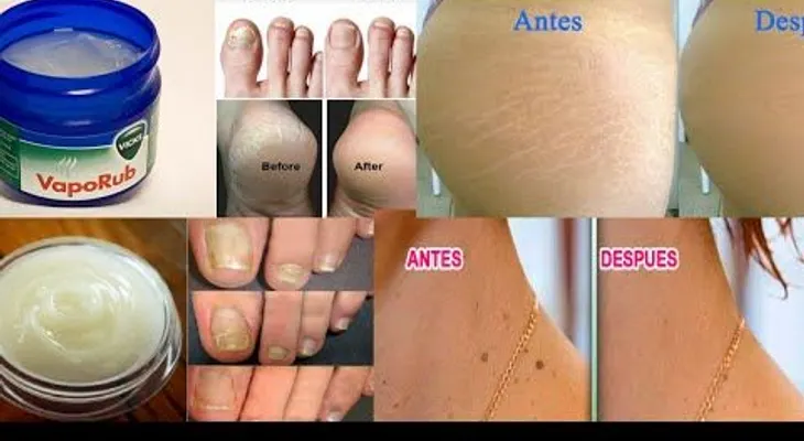 Los increíbles usos del VICKS VAPORUB que nadie te había dicho