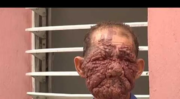 Dominicano con rostro de berrugas recibe ayuda