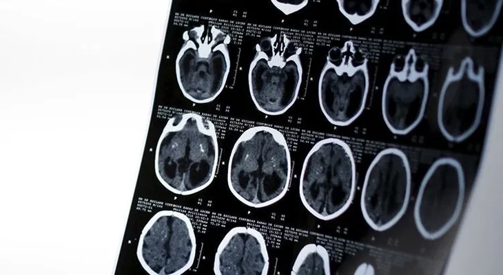 ¿Cómo destruimos nuestro cerebro a diario sin saberlo?