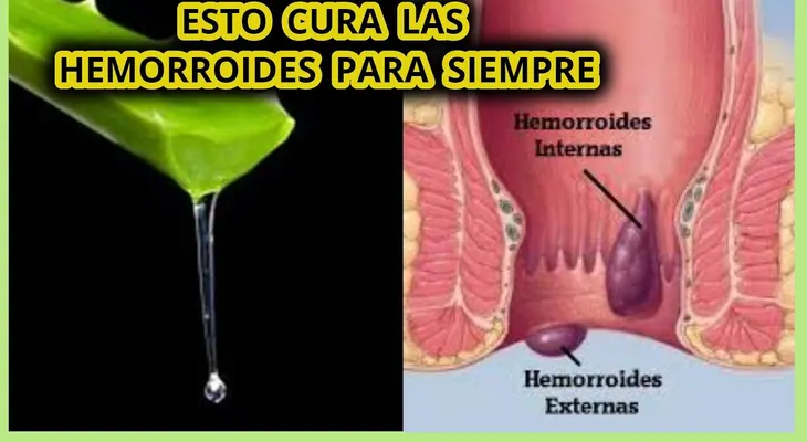 Son dolorosas y causan mucha picazón. Aquí tienes la manera natural de aliviar las hemorroides