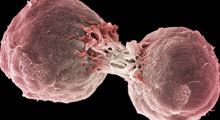  La inmunoterapia lograr por 1ra vez eliminar por completo un cáncer de mama 