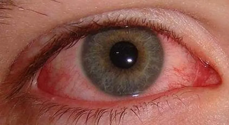  Cómo eliminar enrojecimiento de los ojos. 