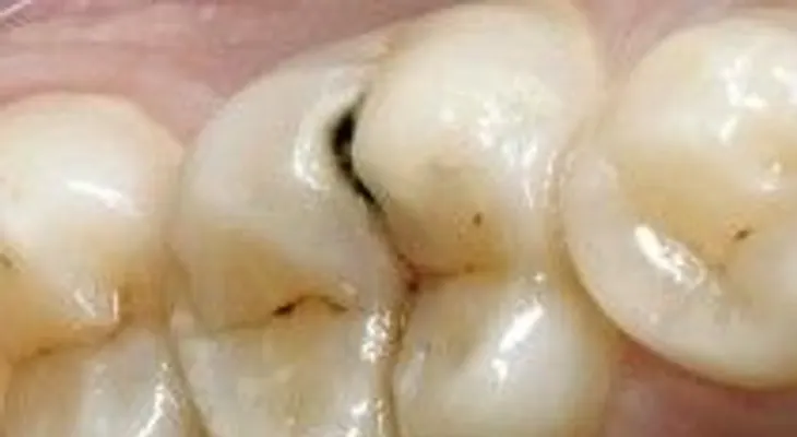 ¡Una técnica probada para curar las caries de los dientes para siempre!