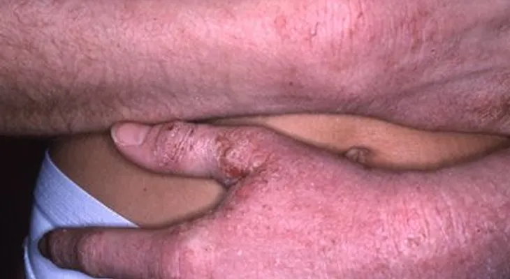 Tratamientos naturales para la demartitis atópica o eczema