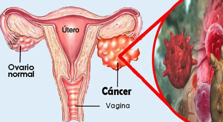 Un 73 por ciento de las mujeres están muriendo por esta enfermedad: esta es la causa principal 
