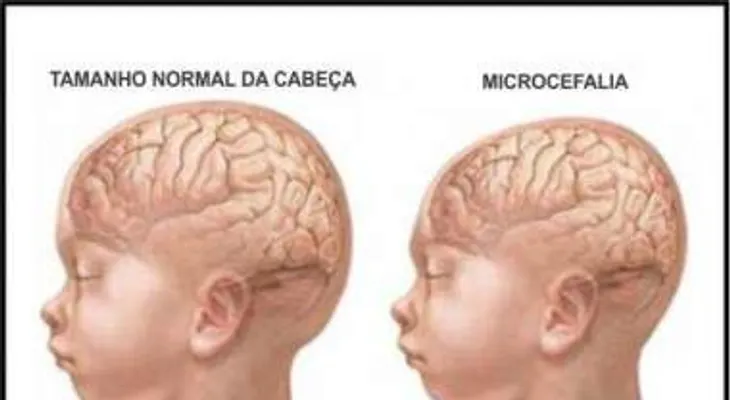 Esperan más casos de microcefalia en el país