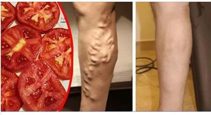 Mis piernas estaban llenas de varices y un doctor me dijo que usará el tomate de esta forma para borrarlas