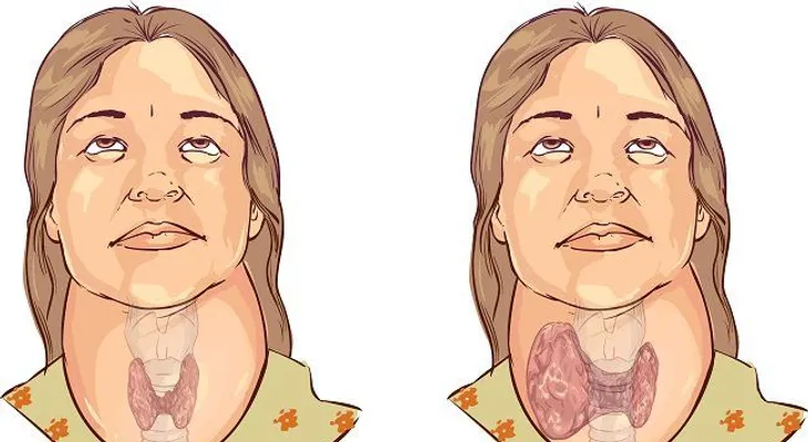 El bocio, sus causas, factores de riesgo y tratamientos naturales