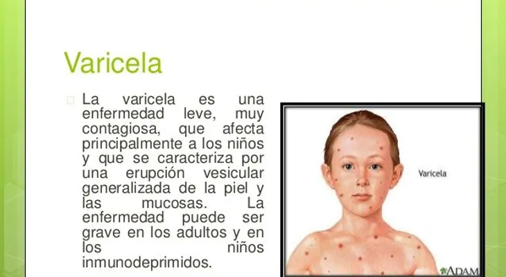  La varicela es una enfermedad sumamente contagiosa, afecta niños y personas mayores