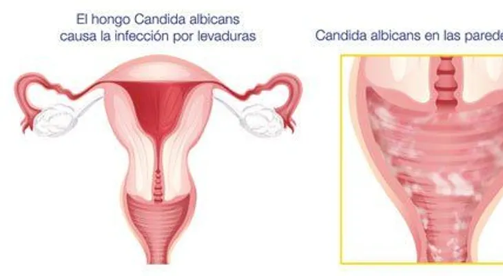 Micosis genital: Factores que contribuyen a la infección 