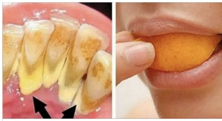 Elimina el sarro y blanquea tus dientes en 15 min con esta receta que un dentista jamás te dirá !